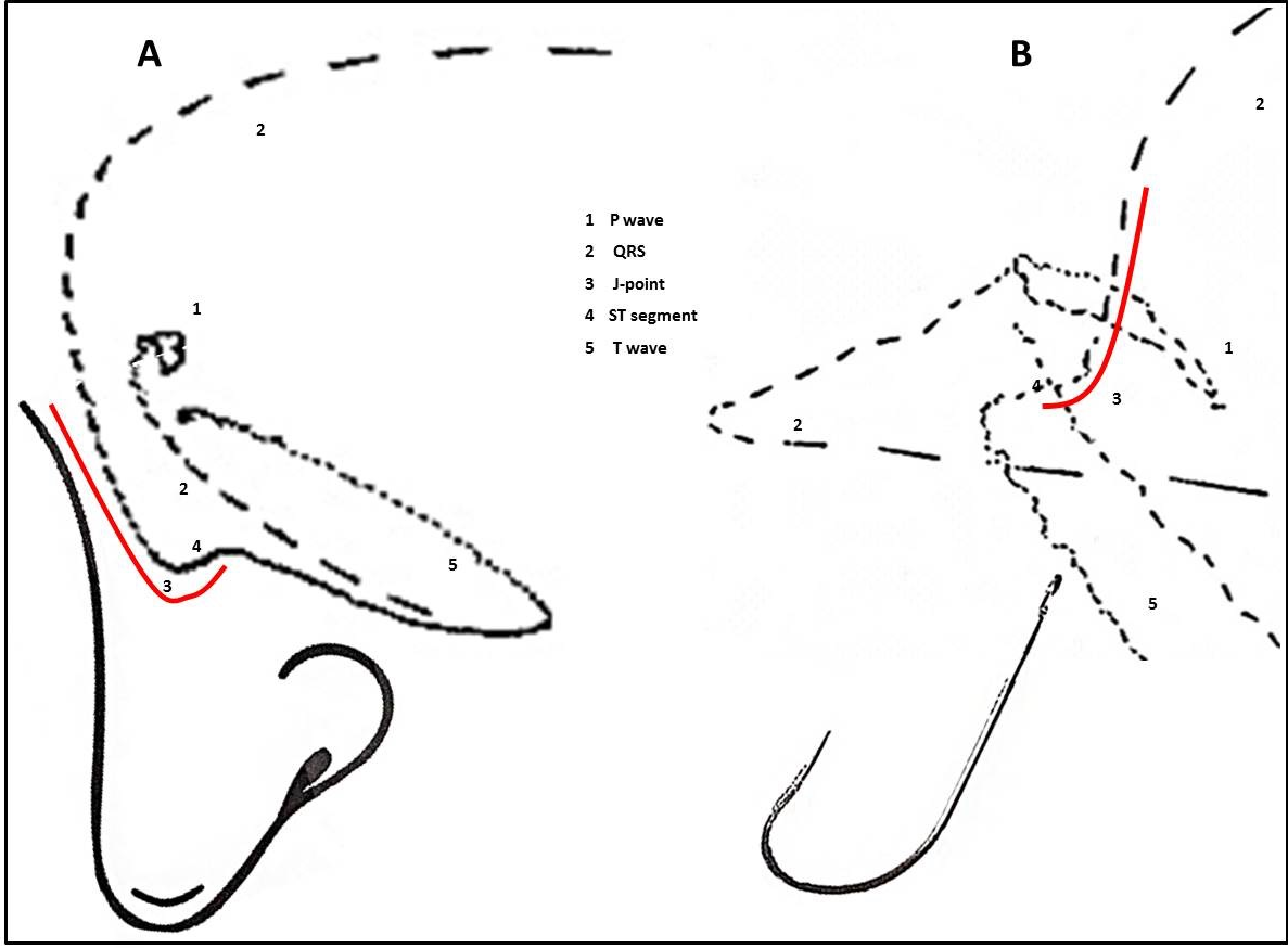 slide from the presentation showing annotated vectorcardiograms